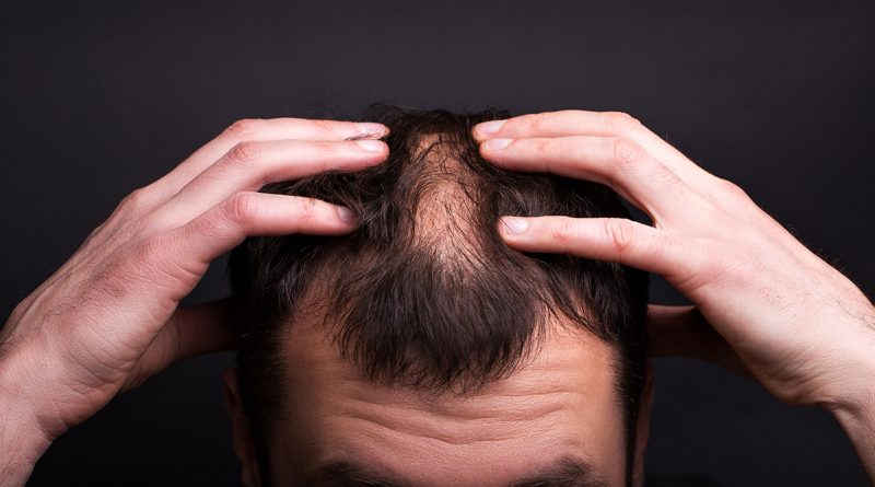 Signs To Look Out For If You Are Balding